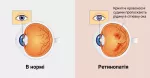 Що таке діабетична ретинопатія?